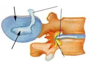 Deštrukcia vláknitého kruhu s cervikálnou osteochondrózou