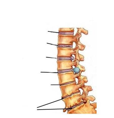 Štádiá rozvoja osteochondrózy