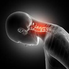 Cervikálna osteochondróza